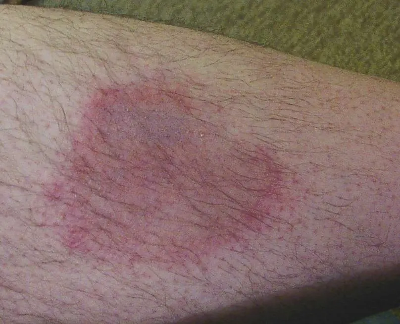 Plaque rouge circulaire sur une jambe, typique d’un érythème migrant