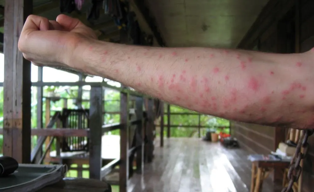Bras couvert de piqûres d’insectes rouges